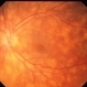 Birdshot Retinochoroidopathy